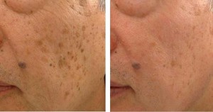 led light therapy for age spots